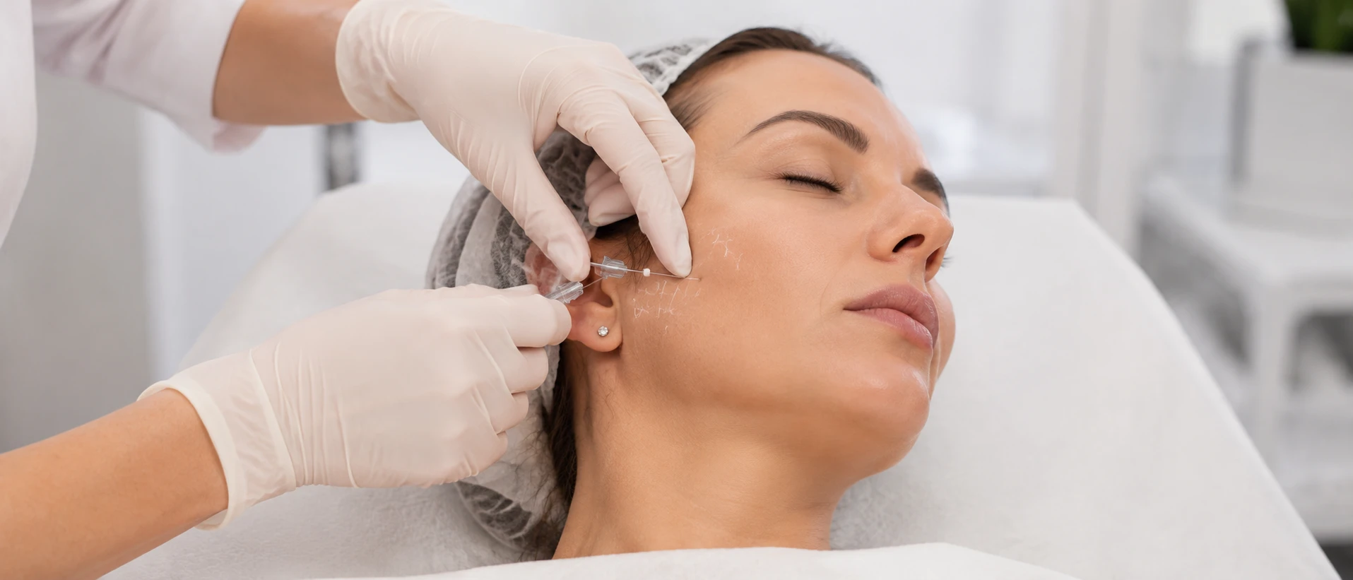 подтяжка кожи лица нитями